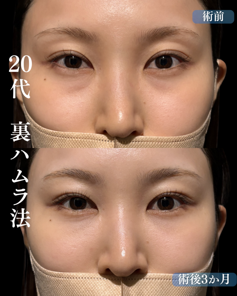 20代女性　裏ハムラ法